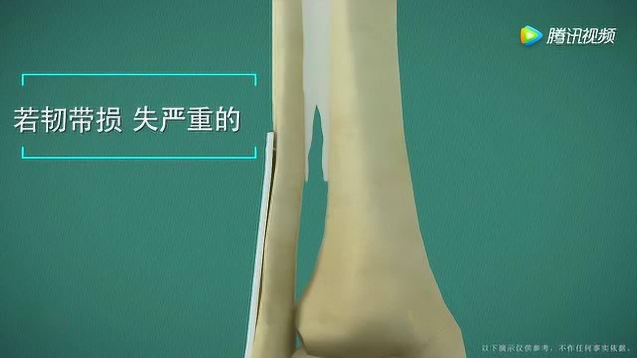 埃因霍温力宣，贝利损失脚踝弹力
